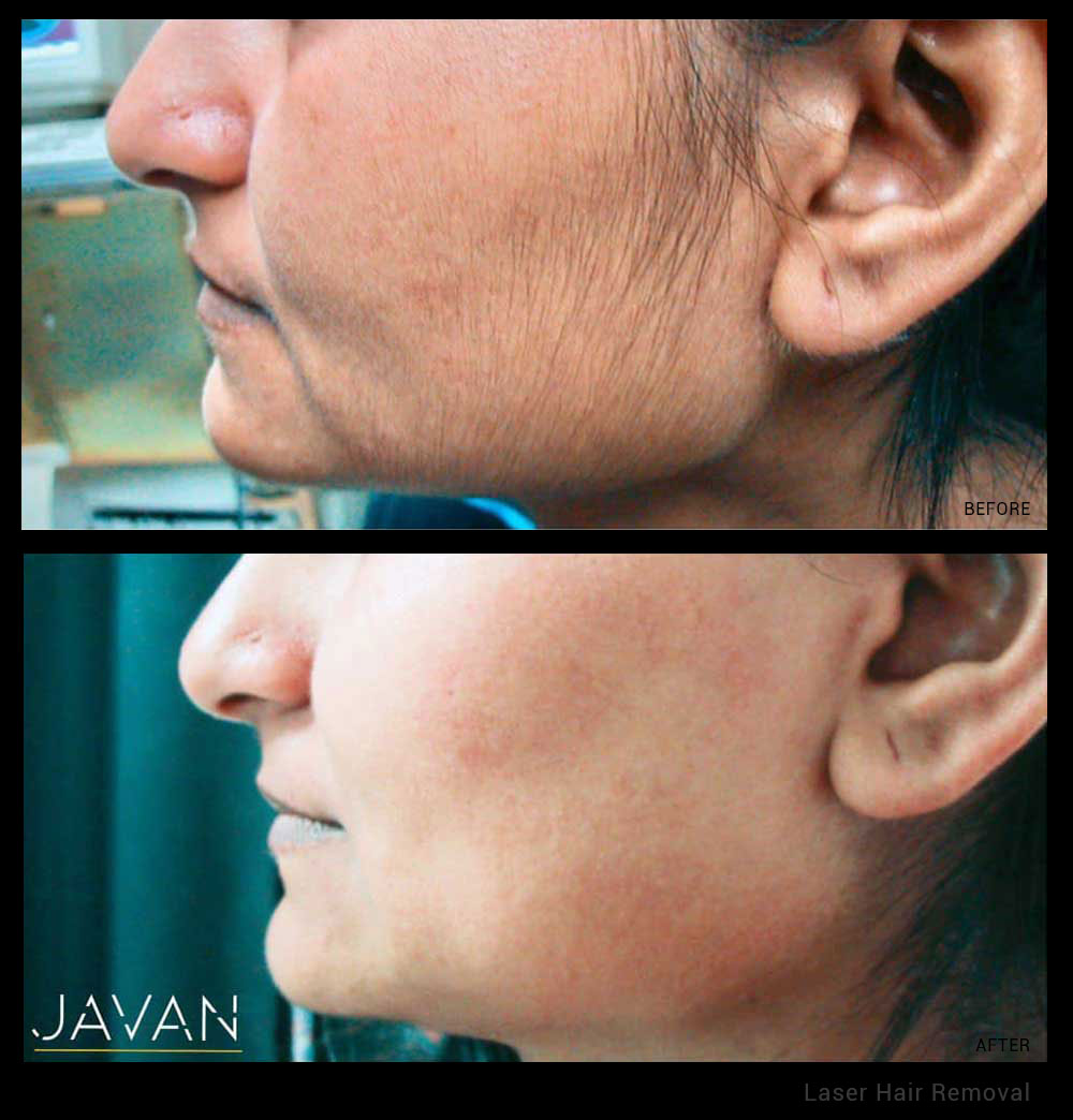 Laser Hair Removal - Javan Anti-Aging and Wellness Institute