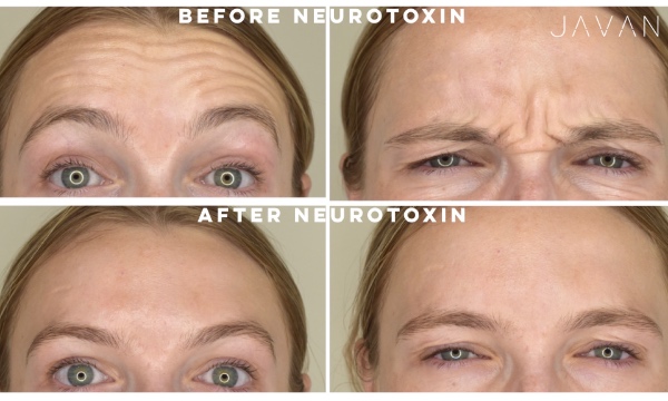 15% off Botox, Xeomin, and Dysport for New Patients